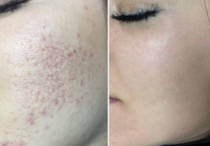 Acne treatment consultation at a dermatology clinic in Kore