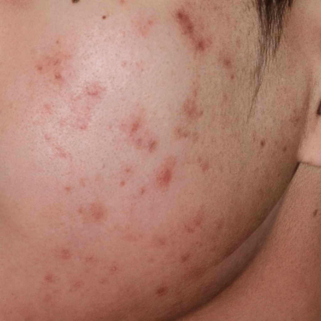 Dermatologist examining acne-prone skin during a consultation